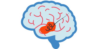 Endovascular Surgery