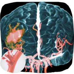 Hemorrhagic Strokes