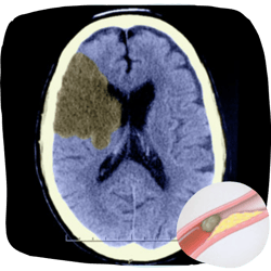 Ischemic Strokes